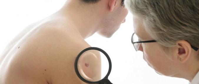 O câncer de pele melanoma, o mais grave, representa 3% das neoplasias malignas da pele